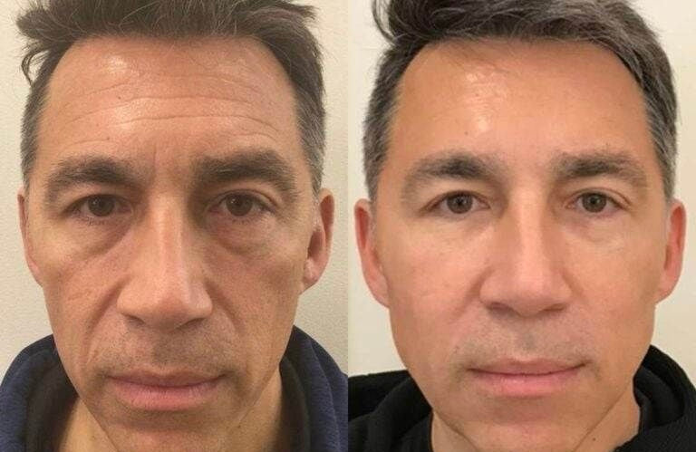 Eye Tightening Cream